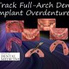 Fast Track Full-Arch Dentistry Implant Overdentures