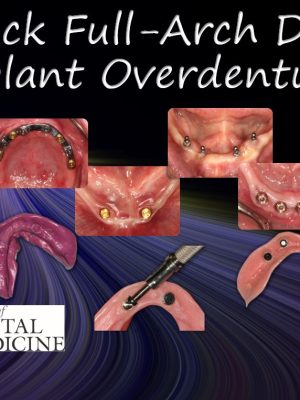 Fast Track Full-Arch Dentistry Implant Overdentures